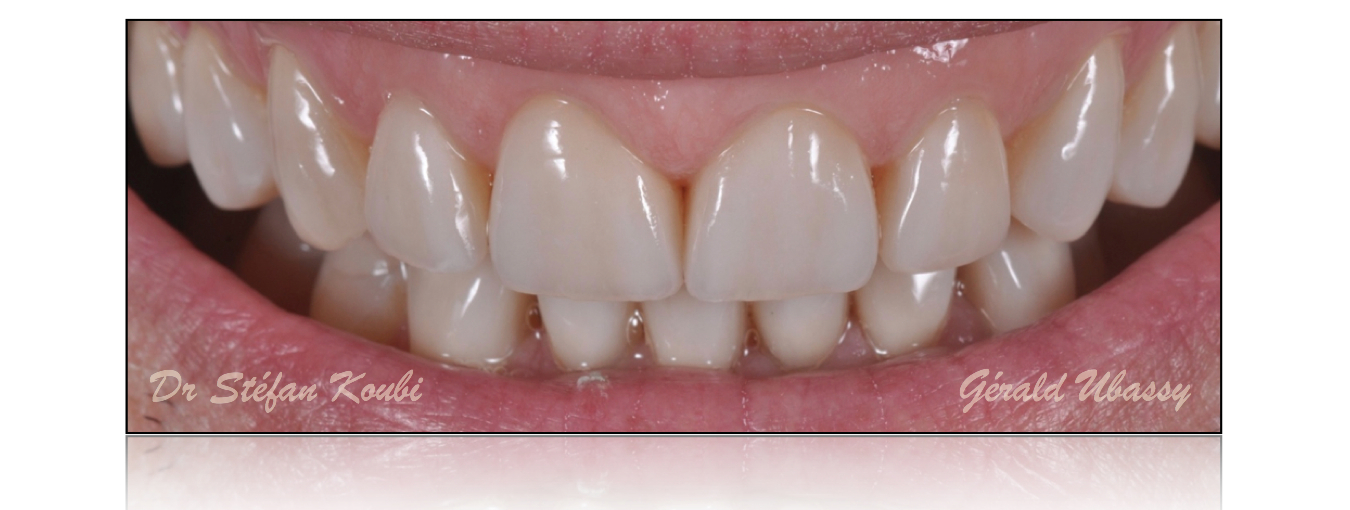 veneers Dr S.Koubi /G.Ubassy